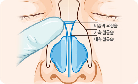 코끝 개선 및 콧등 융비술 1
